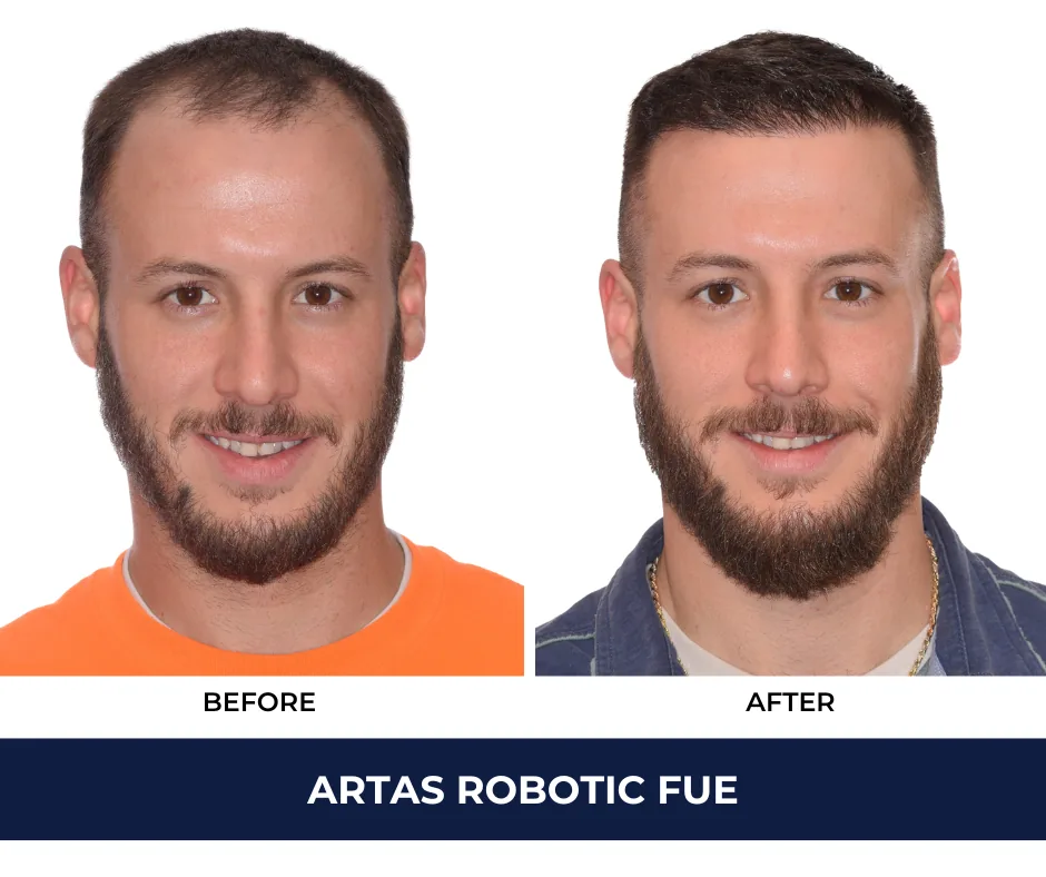Hair transplant Hair Transplant Result before and after