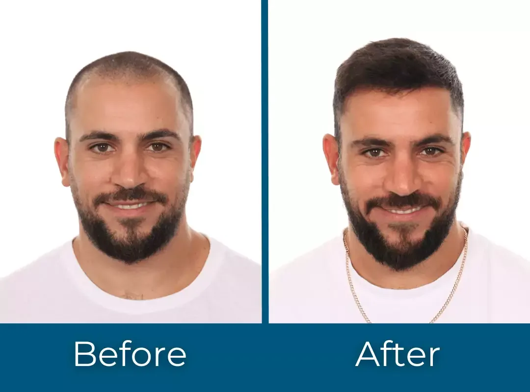 Hair transplant Hair Restoration Result before and after