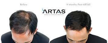 Hair transplant Density Restoration before and after
