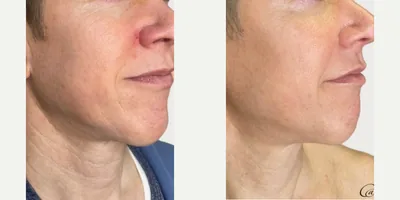 Sylfirm X Jawline & Skin Tightening before and after