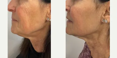 Sylfirm X Neck & Jawline Contouring before and after