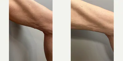 Sylfirm X Skin Laxity & Tightening before and after
