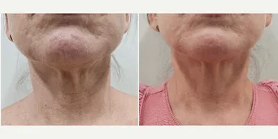 Sylfirm X Neck Rejuvenation before and after