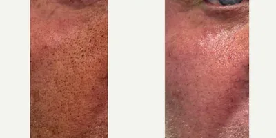 Sylfirm X Pore & Texture Refinement before and after